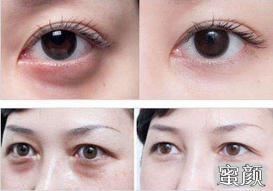 科技揭秘，最新去眼袋最佳方法，重塑眼部美麗新篇章！