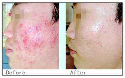 激光祛疤價格詳解，深度解析與觀點闡述