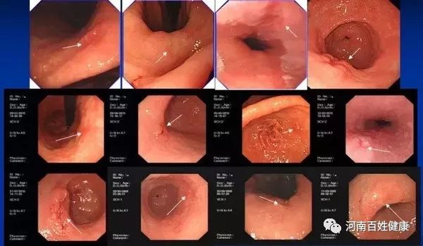 最新胃腸鏡技術(shù)，醫(yī)學(xué)領(lǐng)域的革新之星