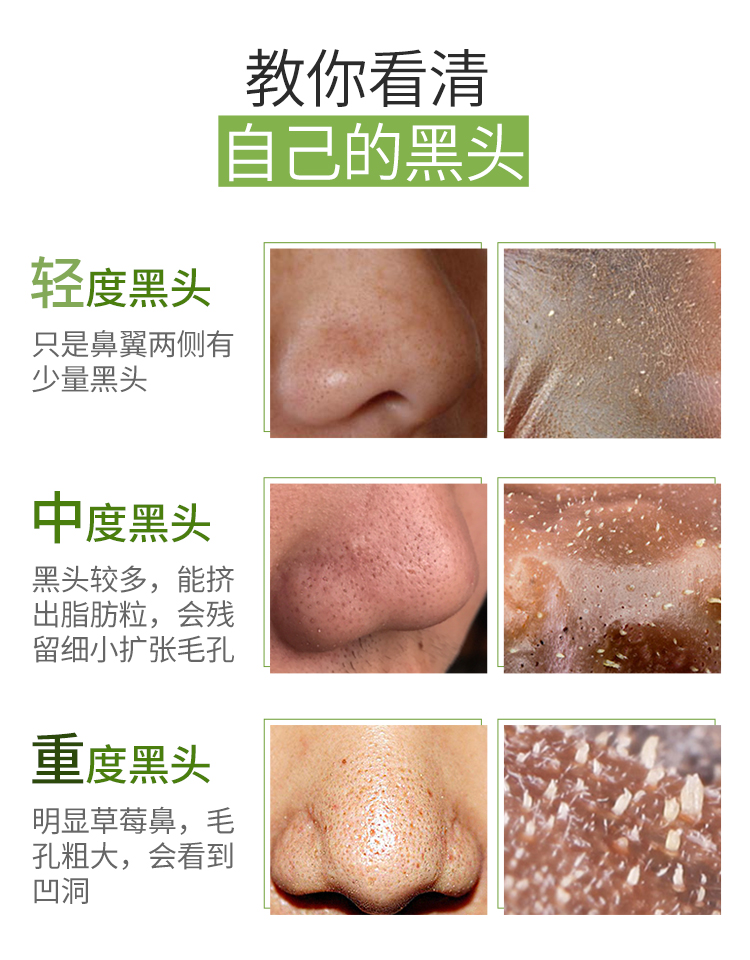 最新去黑頭教程視頻匯總，科技助力美麗重塑，黑頭無憂新篇章