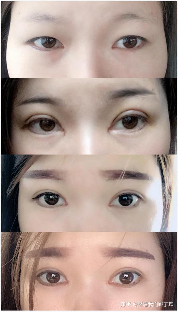 雙眼皮新技術(shù)揭秘，小明的魔法雙眼皮之旅